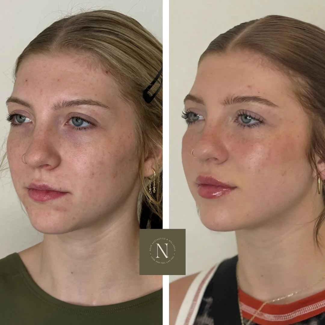 Did you know that lip filler can play a powerful role in facial balancing&mdash;even on its own?

In this treatment, all we did was the lips. No cheeks, no chin, no jawline. But by adding just the right shape, volume, and structure, we brought harmon