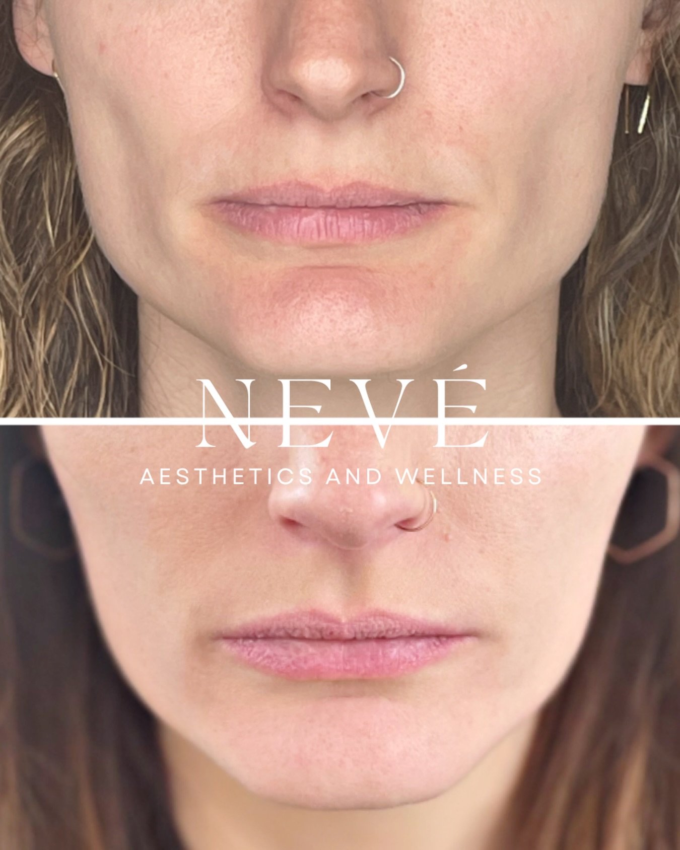 Neurotoxins are often thought of as purely cosmetic &mdash; smoothing lines and relaxing wrinkles. But it can also support overworked masseters. 🤍

Strategic placement may help reduce jaw tension, clicking, and clenching &mdash; while subtly slimmin