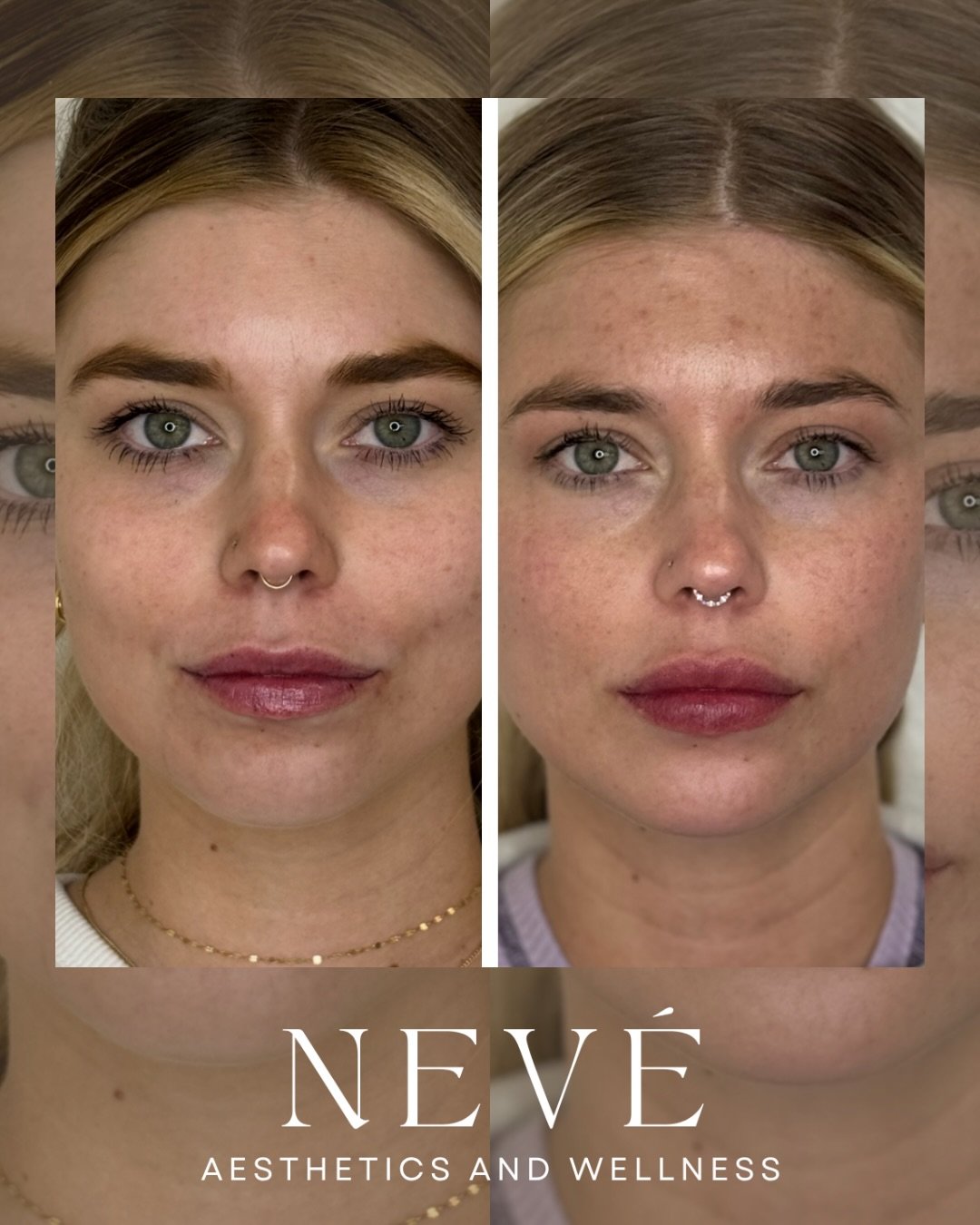 Jade came to us over a year ago for her first filler treatment and then returned for her second session to continue the process of building structure before her wedding day. The result is fuller lips that still maintain their natural shape and moveme