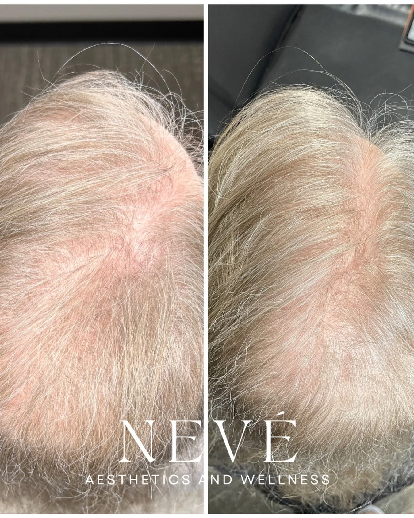 Hair thinning rarely happens overnight &mdash; and restoring it takes strategy.

KeraLase&trade; combines the Lutronic Ultra&trade; laser with Kerafactor&trade; growth factor serum to support scalp health and encourage healthier, fuller-looking hair.