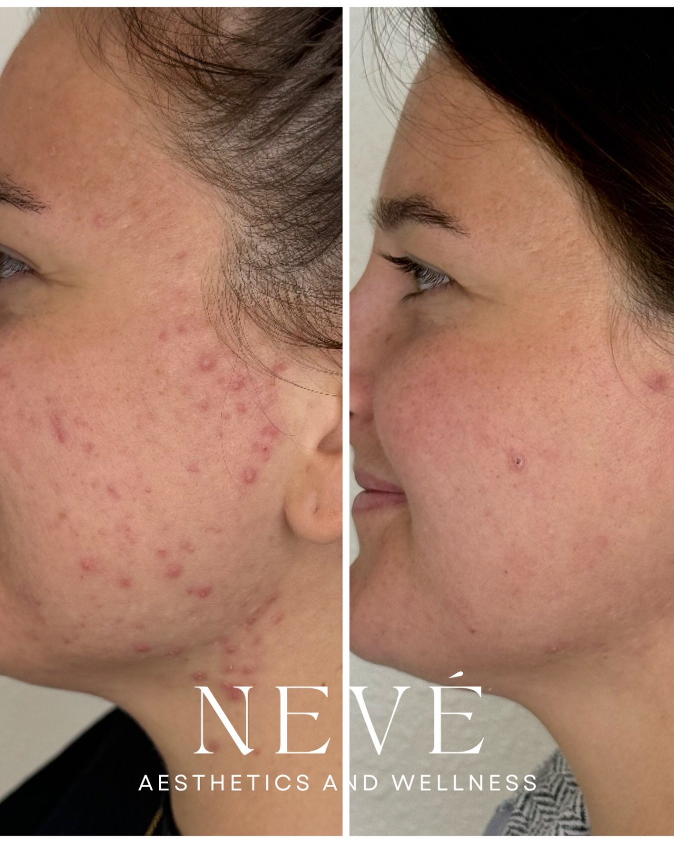 Healing acne is multi-layered &mdash; and it requires strategy, not guesswork.

For this patient, we used a multi-modality approach: laser, targeted Rx support, and microneedling to treat the whole picture &mdash; not just the breakout.

Real progres