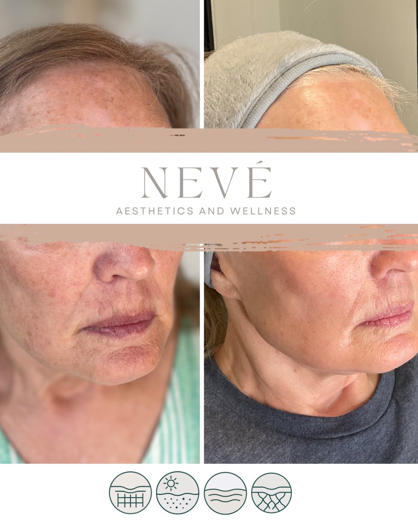 Skin quality takes strategy. ✨

This before and after is after two of three laser treatments and we&rsquo;re already noticing incredible improvements in texture, tone, radiance, and softening of static lines.

Our laser technology is safe for all ski