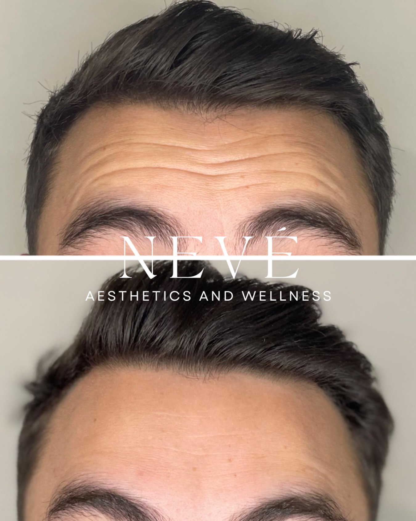 Forehead tox: we can have emotions&hellip; maybe we just don&rsquo;t want to broadcast every single one of them on our forehead. 😉

When done well, it softens lines and keeps things smooth &mdash; without that frozen, surprised look.

The real secre