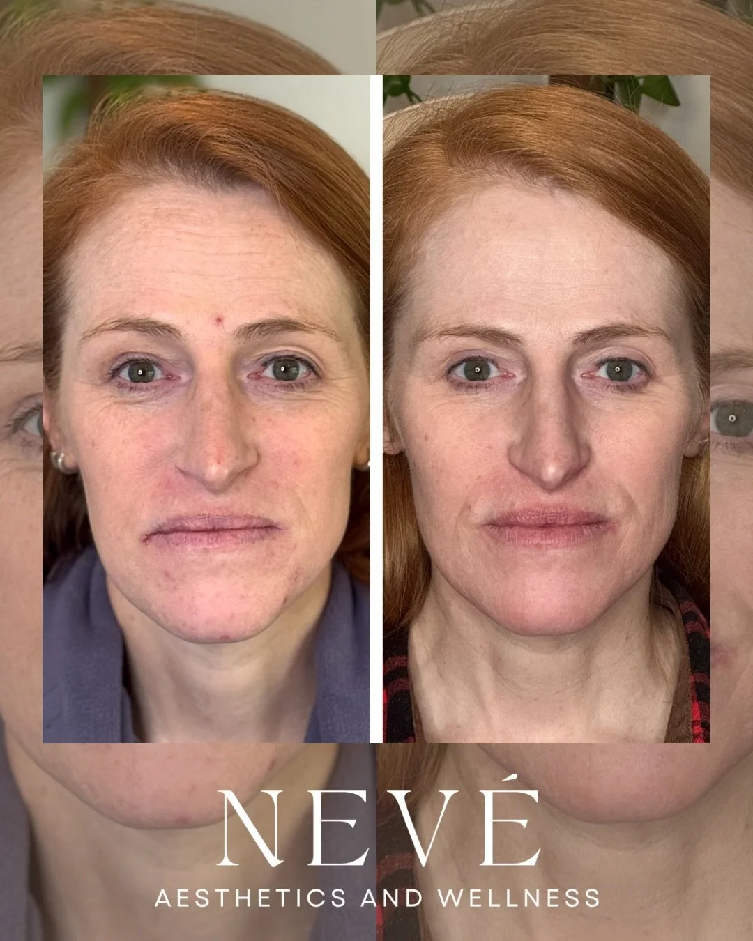 Not every transformation requires injectables.

This Summit County patient chose to focus on improving skin quality through a series of advanced RF and laser treatments as part of our Total Skin protocol. After just a few sessions, we&rsquo;re alread