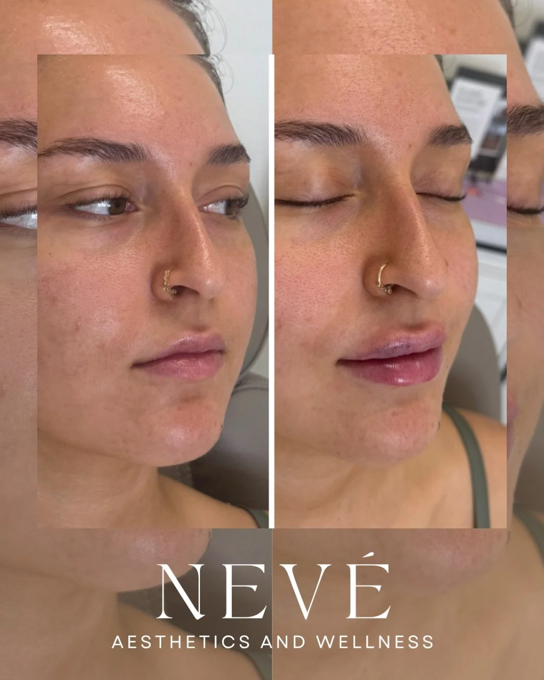 Sometimes the most beautiful results begin with starting fresh.

We dissolved previous filler and rebuilt these lips with intention &mdash; restoring shape, balance, and a little extra volume for impact that still feels effortless. 👄

#lipfiller #co