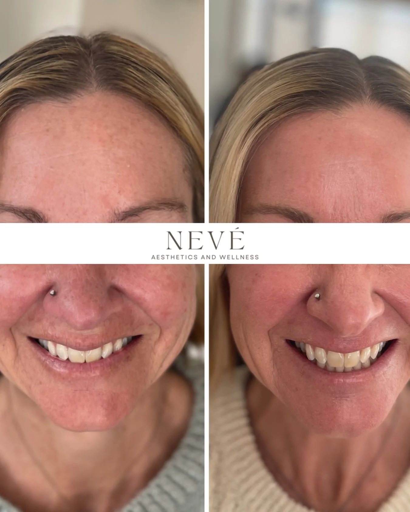 After just one RF session, we&rsquo;re already seeing pigment from sun damage begin to lift, texture smooth, and tone come into balance. Consistent, thoughtful treatments make all the difference. 🤍 

Curious how our Total Skin Solution process can r