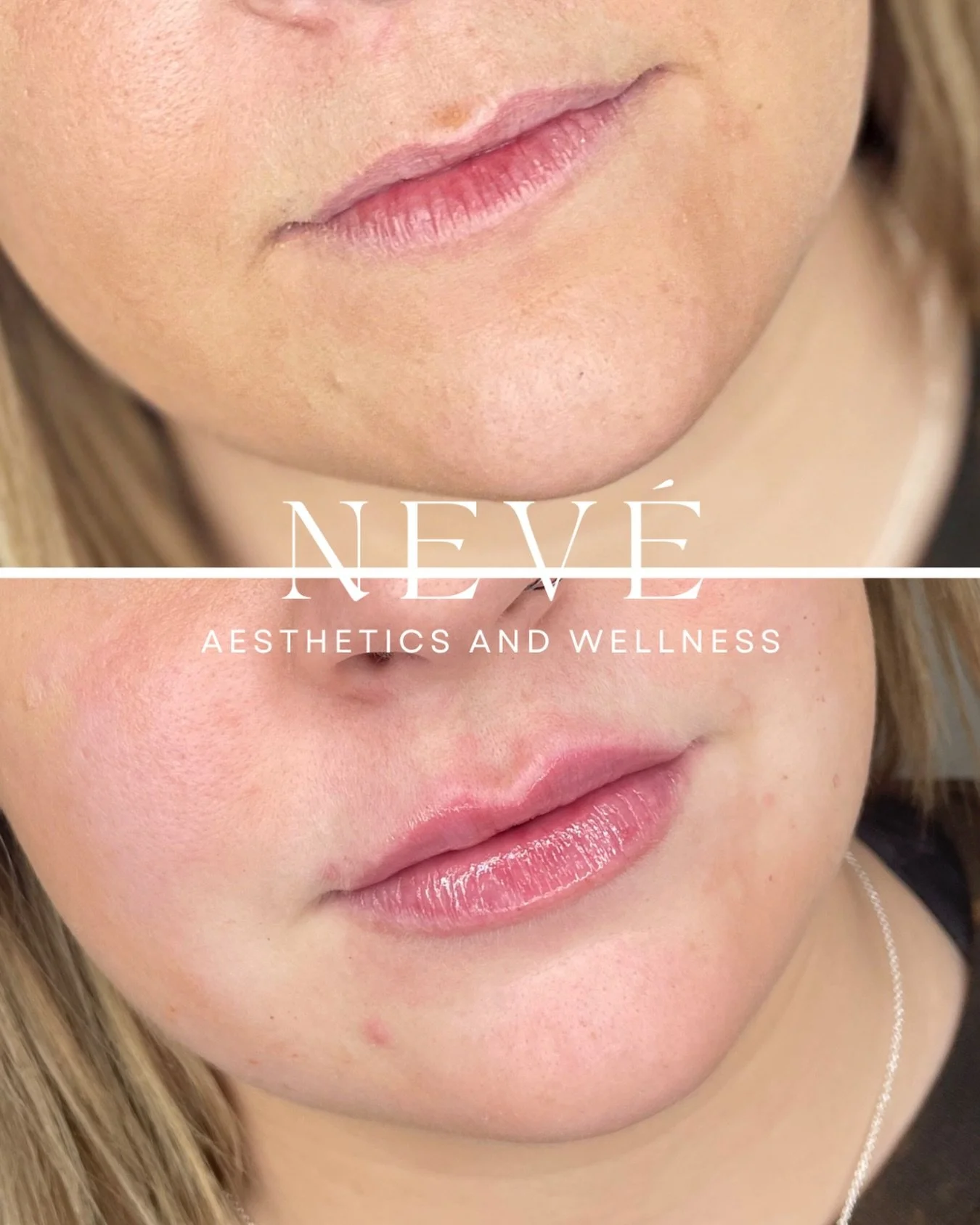 We get it...lips in Colorado always feel dry.
A little hydration, a touch of volume, and thoughtful balance for results that feel as good as they look. 🤍

Online booking available 24/7 - link in bio💋

#coloradomedspa #lipfiller