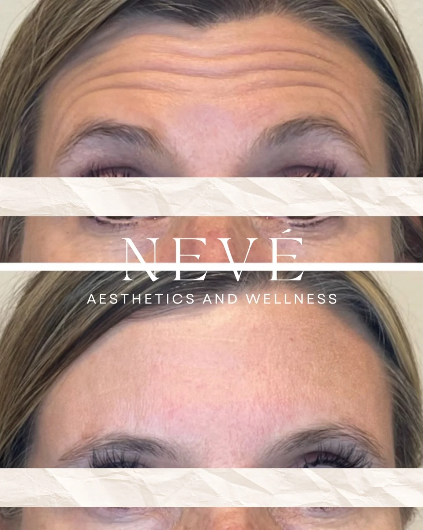 We love a well-executed Dysport&reg; treatment. 
But tox alone won&rsquo;t get you where you want to go.
Come in for a complimentary consultation to learn about our approach to comprehensive skin health&mdash;because treatment plans that address ALL 