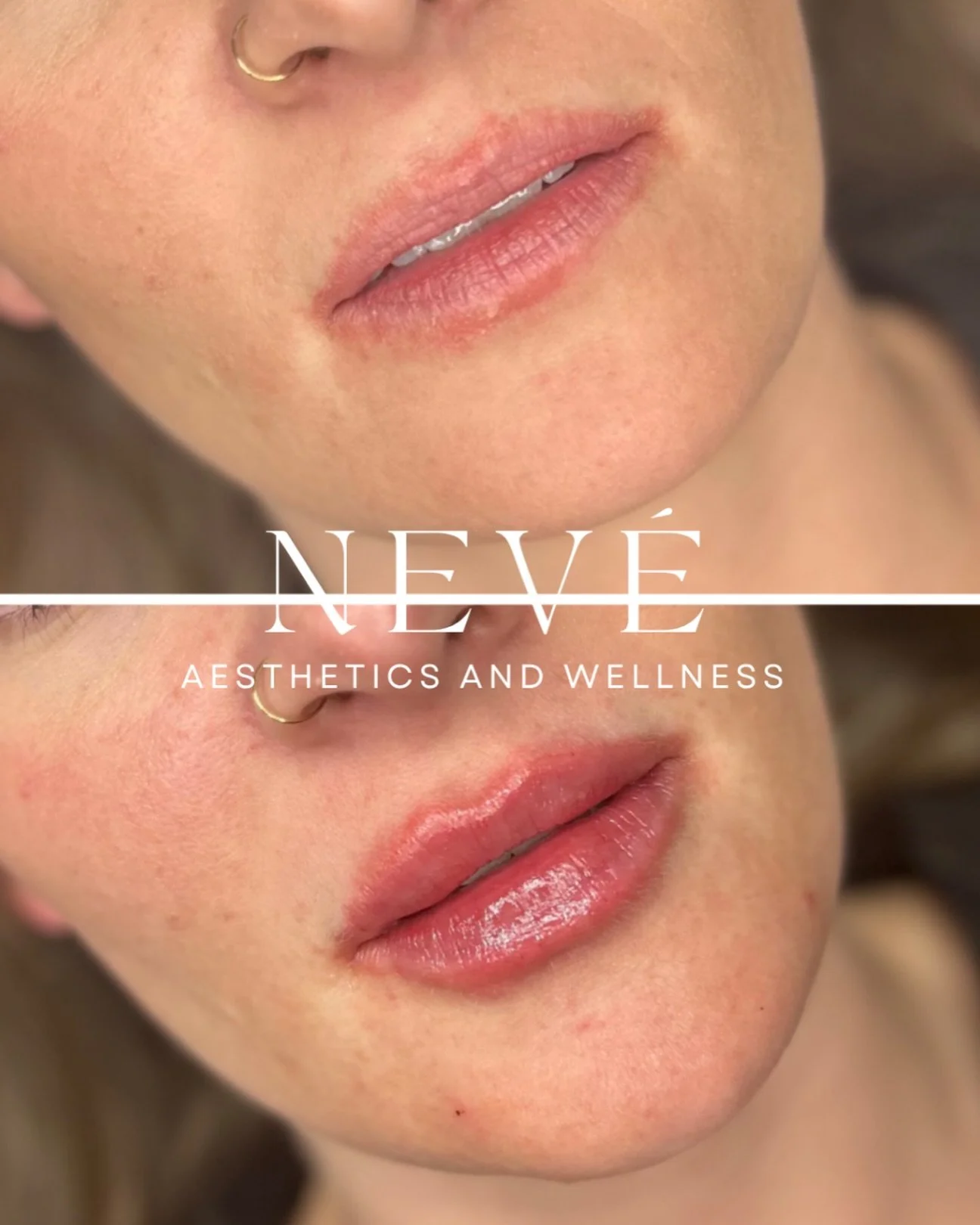 Thinking about lips? 👄

Book your consult or treatment, then send us a DM 
We have a little something special for the first 3 responses 😉💕

#lipfiller #fortcollinsmedspa #summitcounty