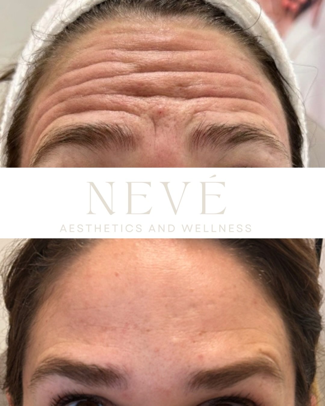 Tox every 3&ndash;4 months won&rsquo;t change your life.
But it will change your relationship with overhead lighting and Zoom calls.

We&rsquo;ll take the win.

Schedule your next refresh - Link in bio ✨

#neurotoxins #wrinklesbegone #wellnessspa #fo