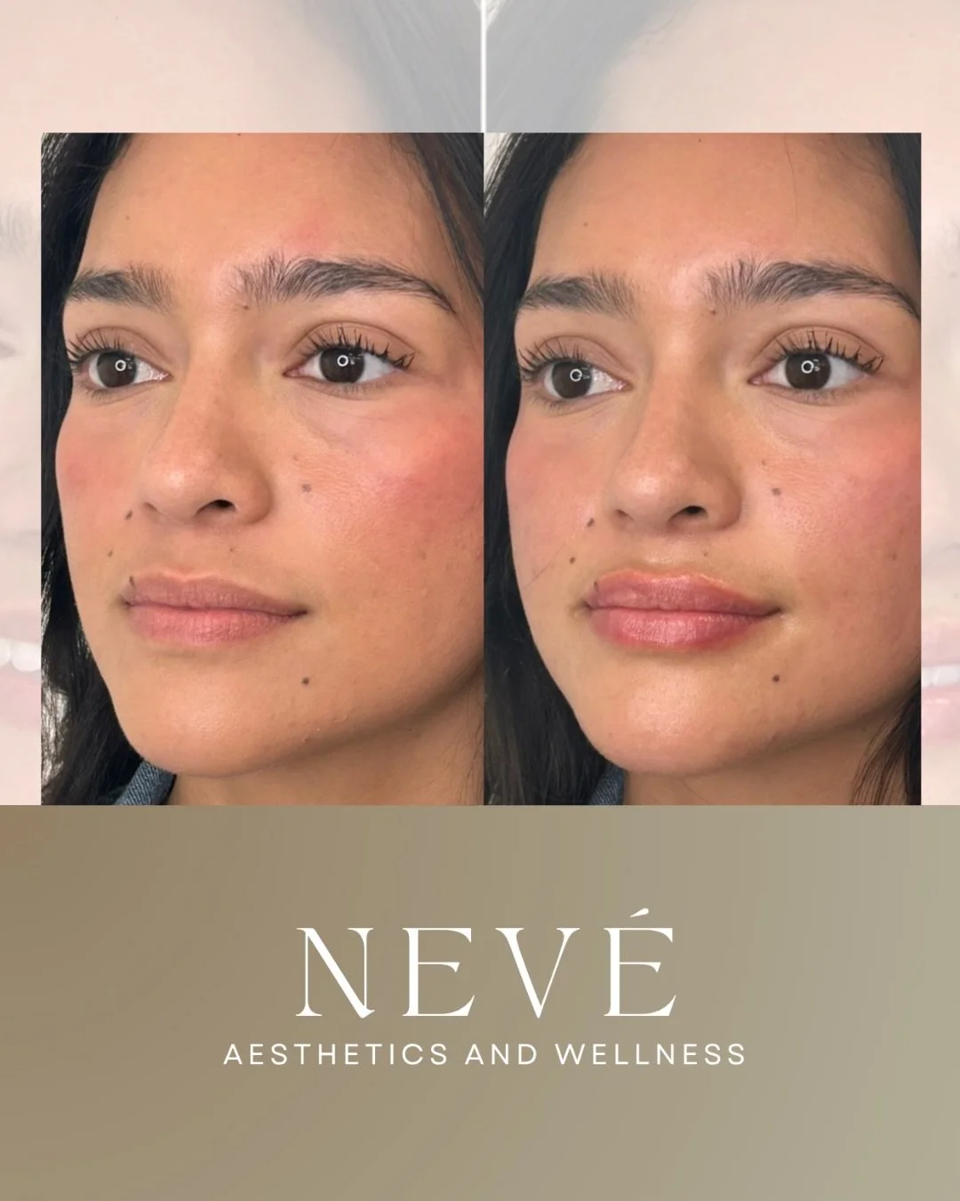 We love a perfect pout&mdash;but it&rsquo;s rarely a quick decision, and it shouldn&rsquo;t be.

Thoughtful technique. Intentional placement. The right product for you.

Our providers understand the nuance required for results that look and move natu