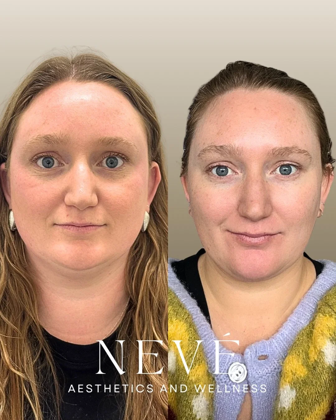 TMJ relief + subtle facial balancing = one of our favorite combinations ✨

Our Clinic Manager, Madi, came in wanting a smoother, refreshed look while still keeping natural expression and movement. She also struggles with teeth grinding. We treated:
&