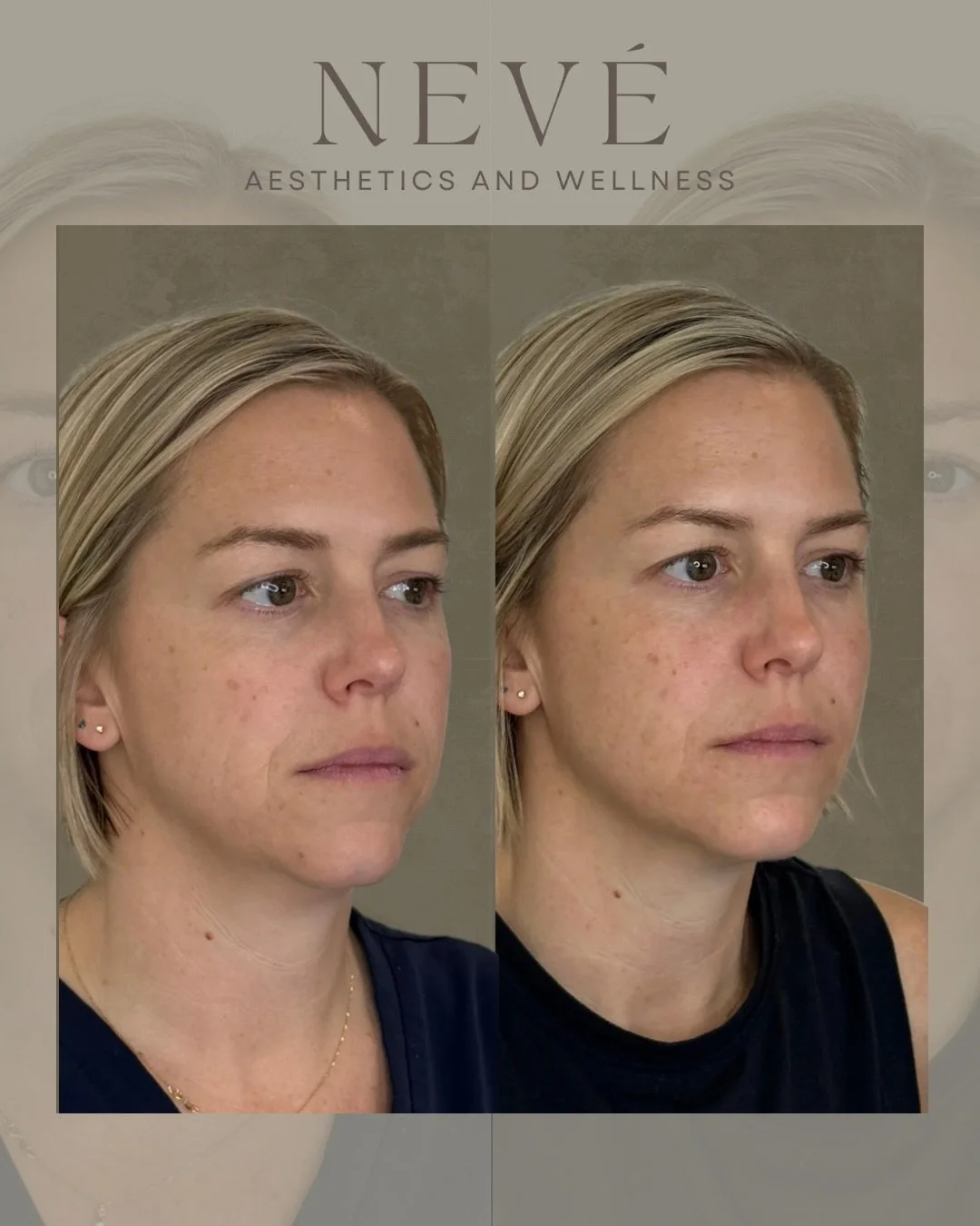 Facial balancing isn&rsquo;t about major structural changes. It&rsquo;s the art of subtle refinement &mdash; understanding facial proportions, movement, and how light naturally reflects across the face to create harmony.

For this patient, treatment 