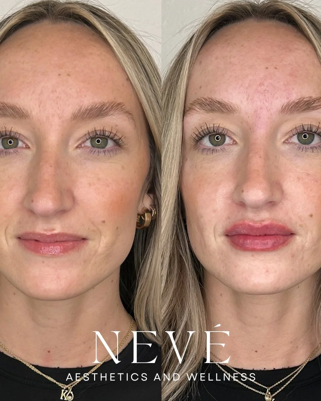 Not all lip filler is the same &mdash; and waiting until you find a provider you truly trust matters more than people realize.

The best results come from listening first. Your goals, your features, your comfort level, your vision. Provider, product,