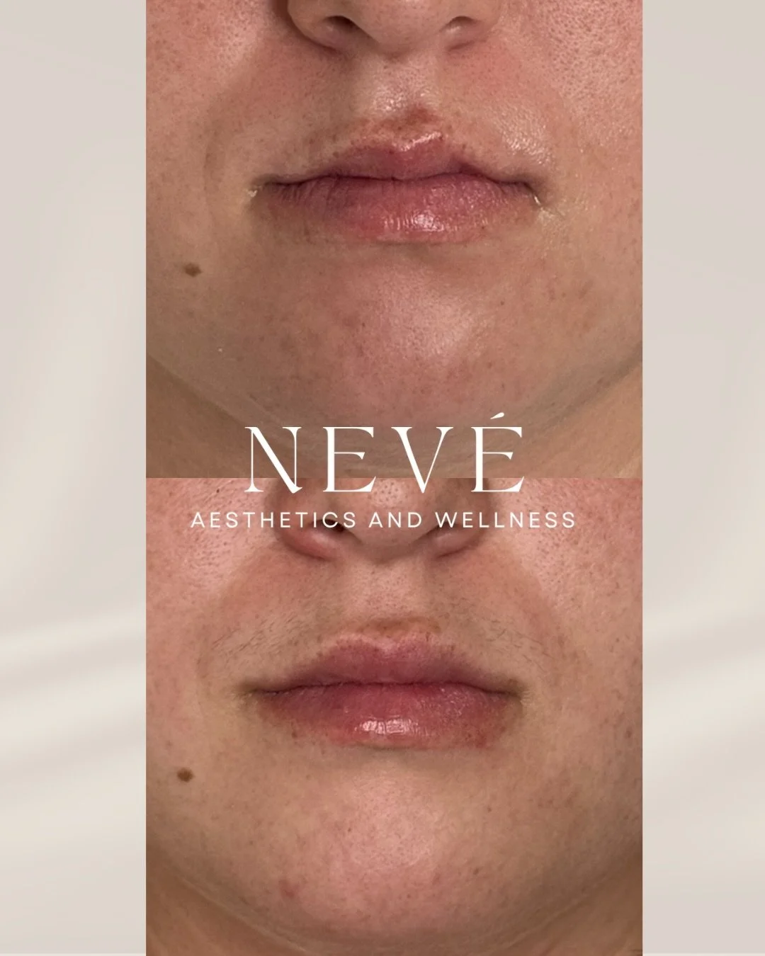 Some lips require a more thoughtful approach than simply adding volume. ✨

This patient had a naturally pronounced M-shape, so the goal was to soften, restructure, and create better balance while still keeping the lips natural and true to her feature