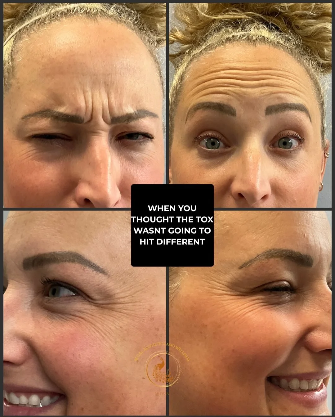 It’s Tox Tuesday — your weekly reminder that smooth, youthful skin is just a few units away! Whether it’s softening frown lines or keeping your glow on point, neuromodulators like Xeomin deliver results you’ll love. Book your