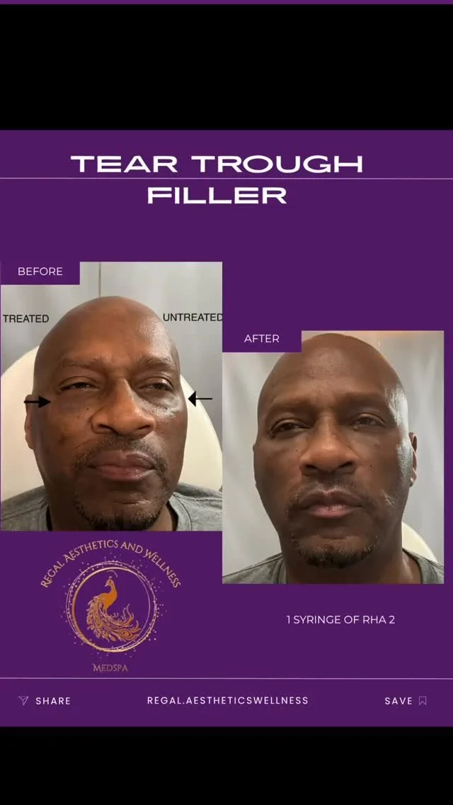 β¨Who says men cant get filler! Subtle tweak. Major upgrade πͺπΎ This male client received precisely placed tear trough filler to decrease dark circles and hollowness yielding a restored, rested, and confident look — without looking “done.