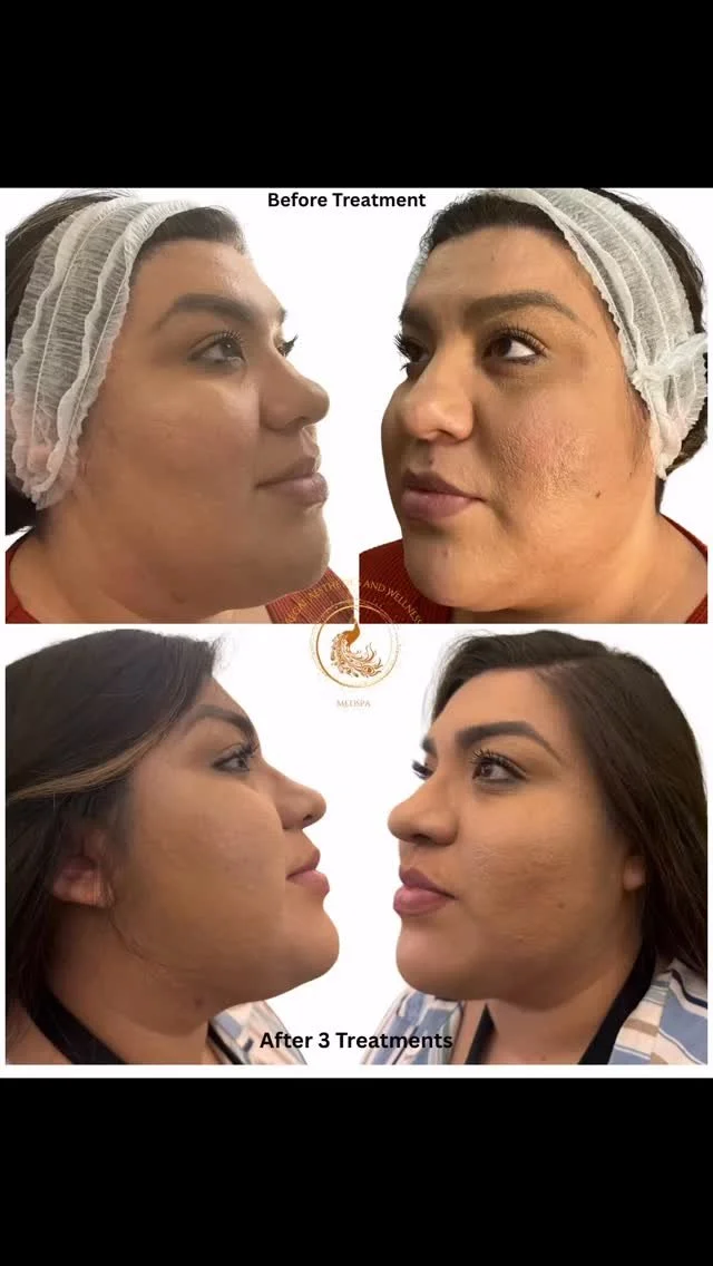 From dull to dazzling — in just 3 sessions. π¦
This is what happens when collagen meets consistency. Our Microneedling treatments resurface, tighten, and rejuvenate your skin — fading scars, softening fine lines, smoothing uneven texture