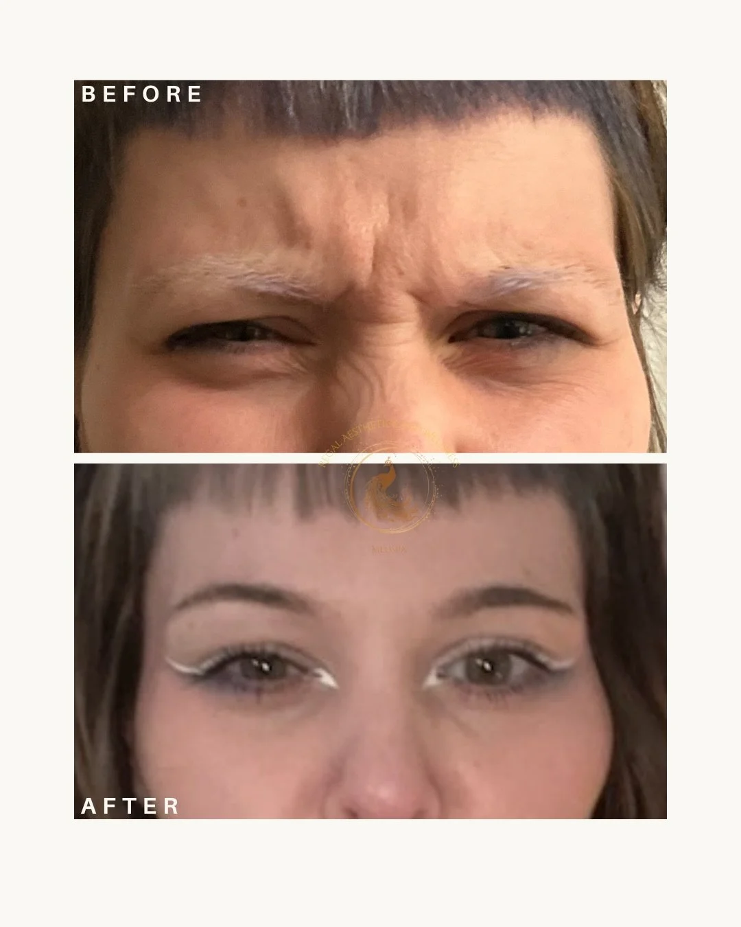 Tox results that speak for themselves.
Frown lines softened, bunny lines smoothed, and a subtle lip flip to finish it off. Precision placement, balanced results, and a refreshed look that still feels like you&mdash;just glowing and confident.

If you