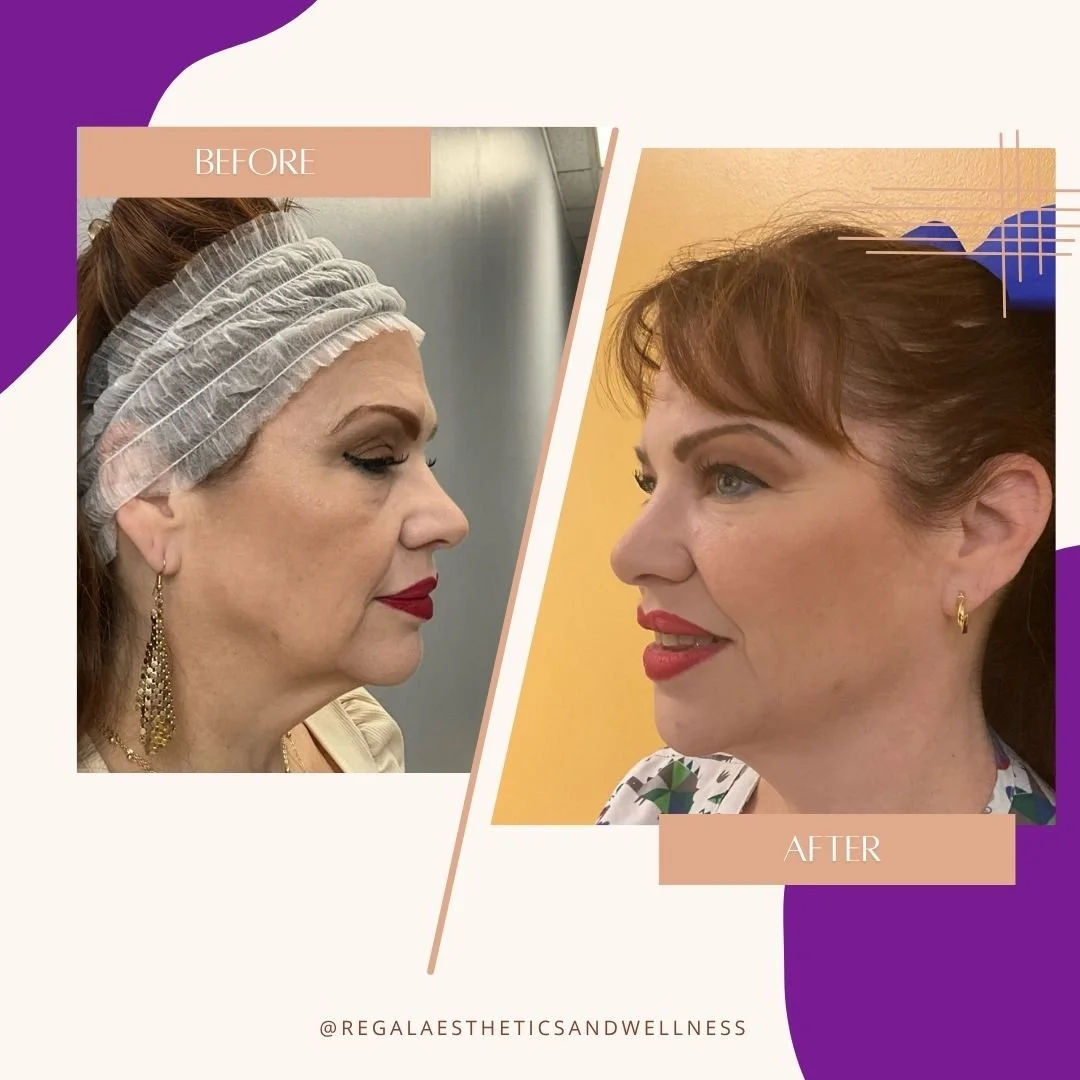 Comparison of a woman's face before and after cosmetic or skincare treatment, showing smoother skin and enhanced features.