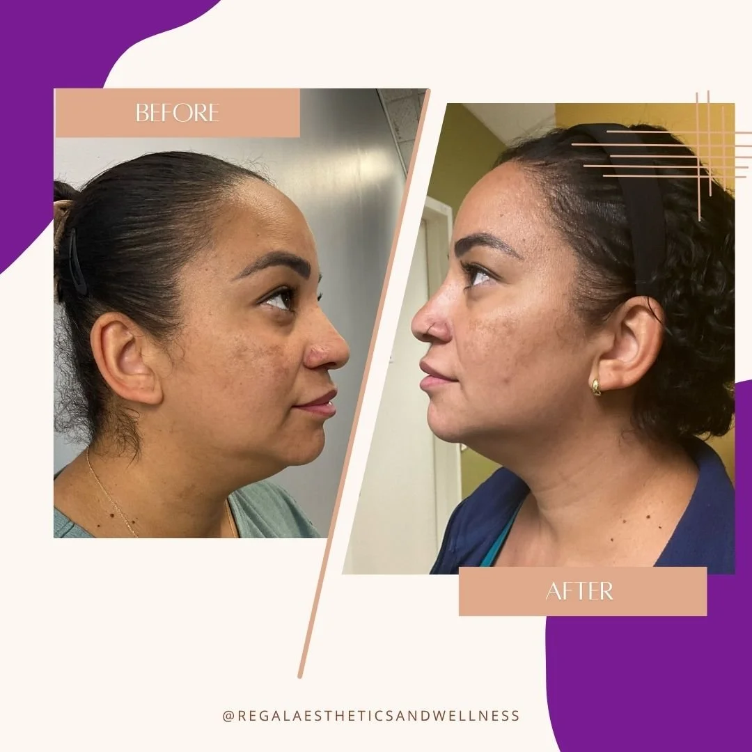 Side-by-side before and after photos of a woman showcasing facial skin improvement, with the before image showing uneven skin tone and texture, and the after image displaying clearer, smoother skin.