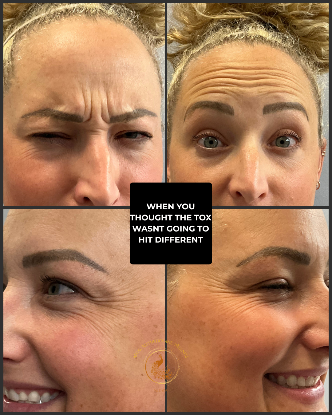 A collage of four close-up photos of a woman showing facial expressions before and after toxin treatment, with wrinkles and fine lines visible, and a message in the center that reads "When you thought the toxin wasn't going to hit different."