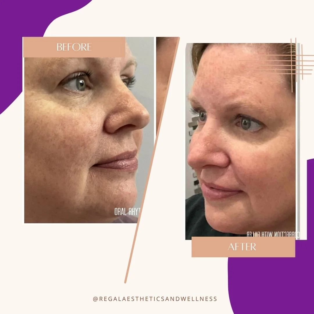 Side-by-side comparison of a woman's face before and after cosmetic treatment, showing improved skin texture and tone.