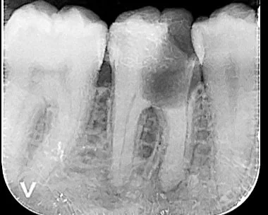 surgery lower 2nd molar.jpg
