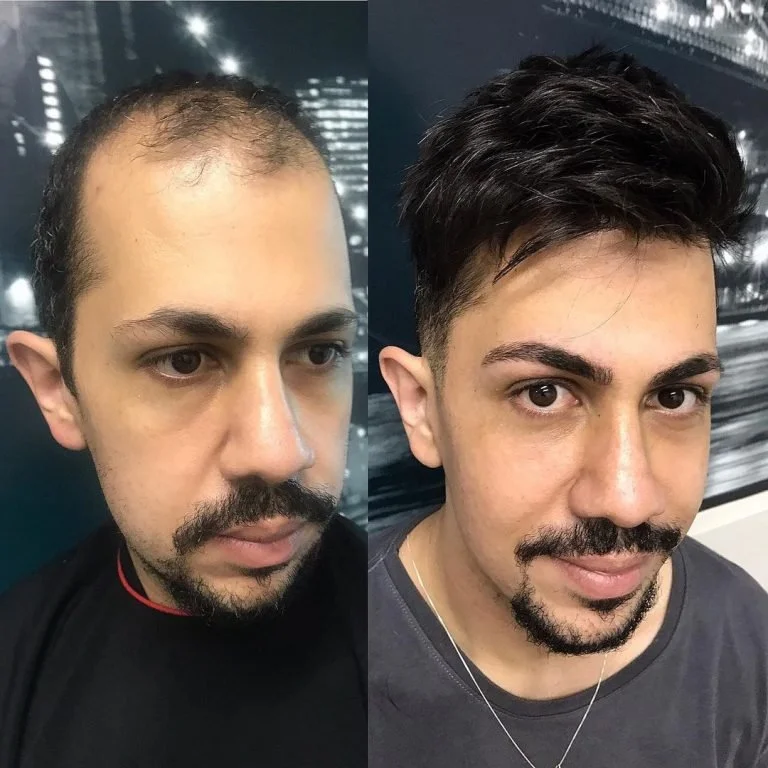 Pessoa apresentando antes e depois de um renovado visual de cabelo e barba, com mudanças visíveis no cabelo e estilo de barba.