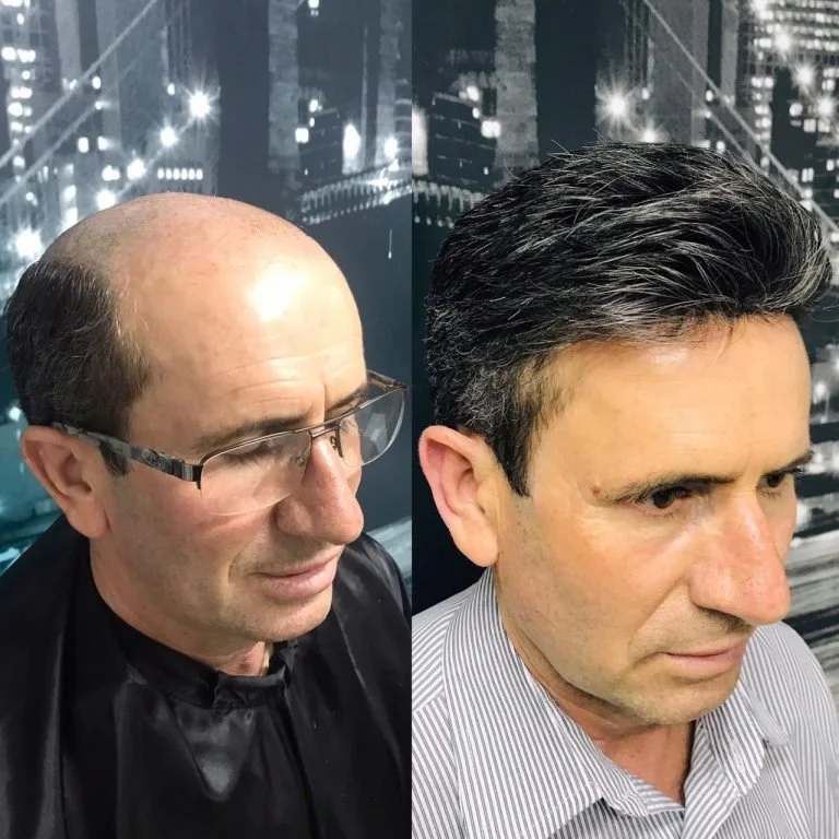 Antes e depois de uma transformação capilar em um homem de cabelo ralo, mostrando a mudança de cabelo fino e com pouco volume para cabelo mais espesso e estilizado.