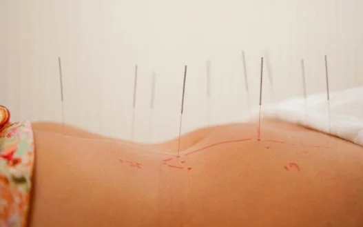 Acupuncture in Surrogacy