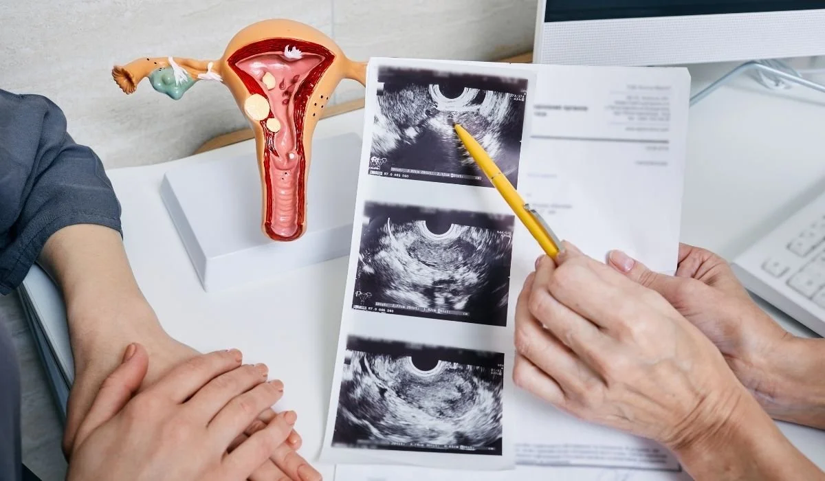 Polycystic Ovarian Syndrome Attributes