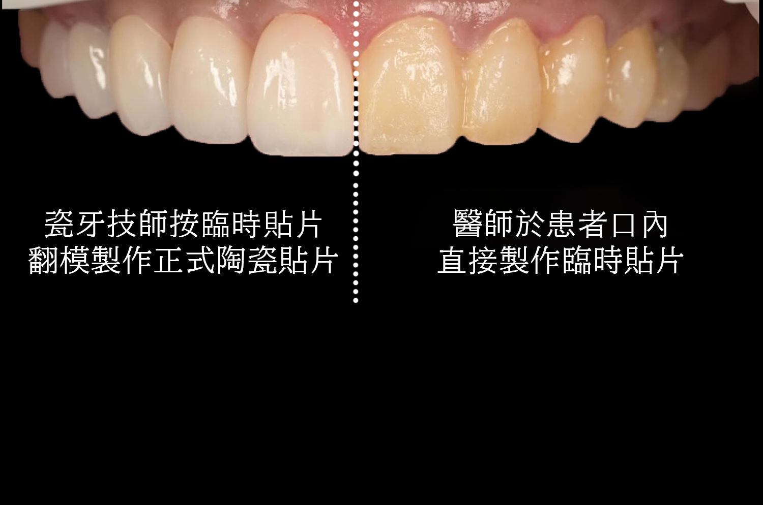 什麼是動態美學微笑設計?陶瓷貼片打造專屬你的自然笑容 | 羅氏審美牙科診所