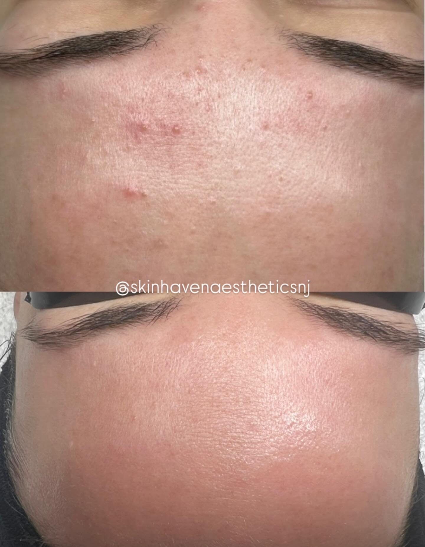 Real skin transformation in 3 months 

This before &amp; after shows my client&rsquo;s forehead from November to now, starting with inflamed, congested breakouts and transforming into clear, smooth, healthy skin.

With a customized treatment plan, co