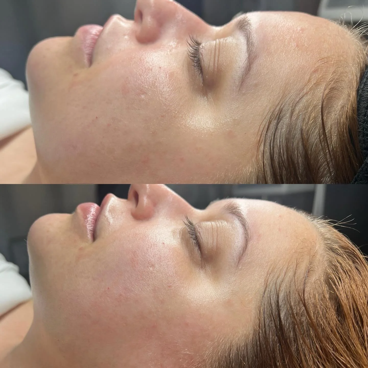 Hydroluxx Glow Up
Before ➡️ After

This is what happens when we deeply cleanse, exfoliate, and infuse the skin with hydration using my Zemits Hydroluxx treatment 

In just one session, we&rsquo;re targeting:
✔️ congestion + dullness
✔️ dehydration
✔️