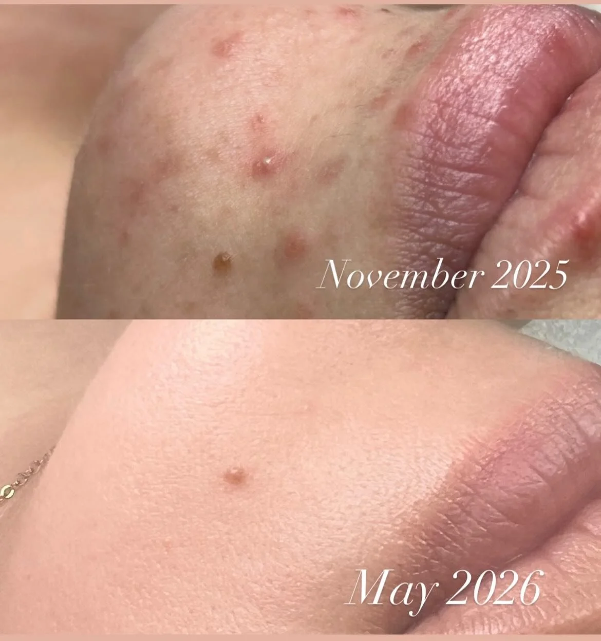 Nothing makes me happier than watching my clients gain confidence through healthy, healing skin. 🤍 These results are proof that consistency, patience, customized treatments, and commitment truly pay off. So proud of my client and so grateful for her