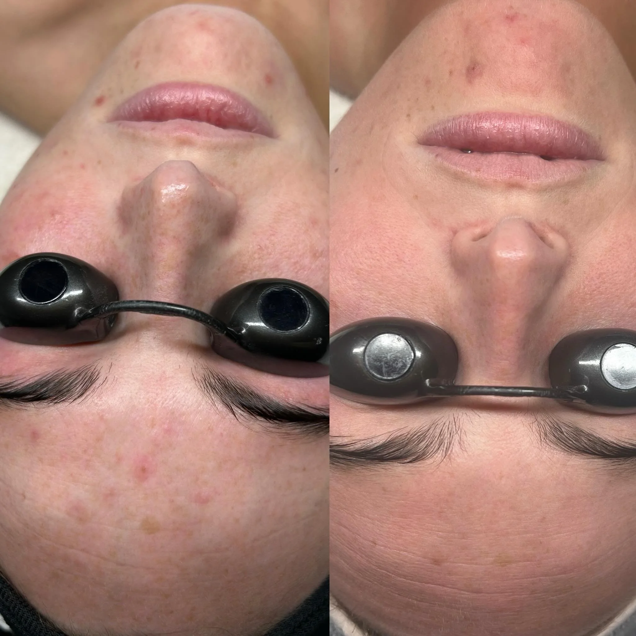 Her skin went from angry and inflamed to healthy and calm! 

In just 5 weeks from our first time meeting she stayed consistent with her face reality customized routine. Her skin began to thrive and immediately transform. 

#facerealityskincare #facer