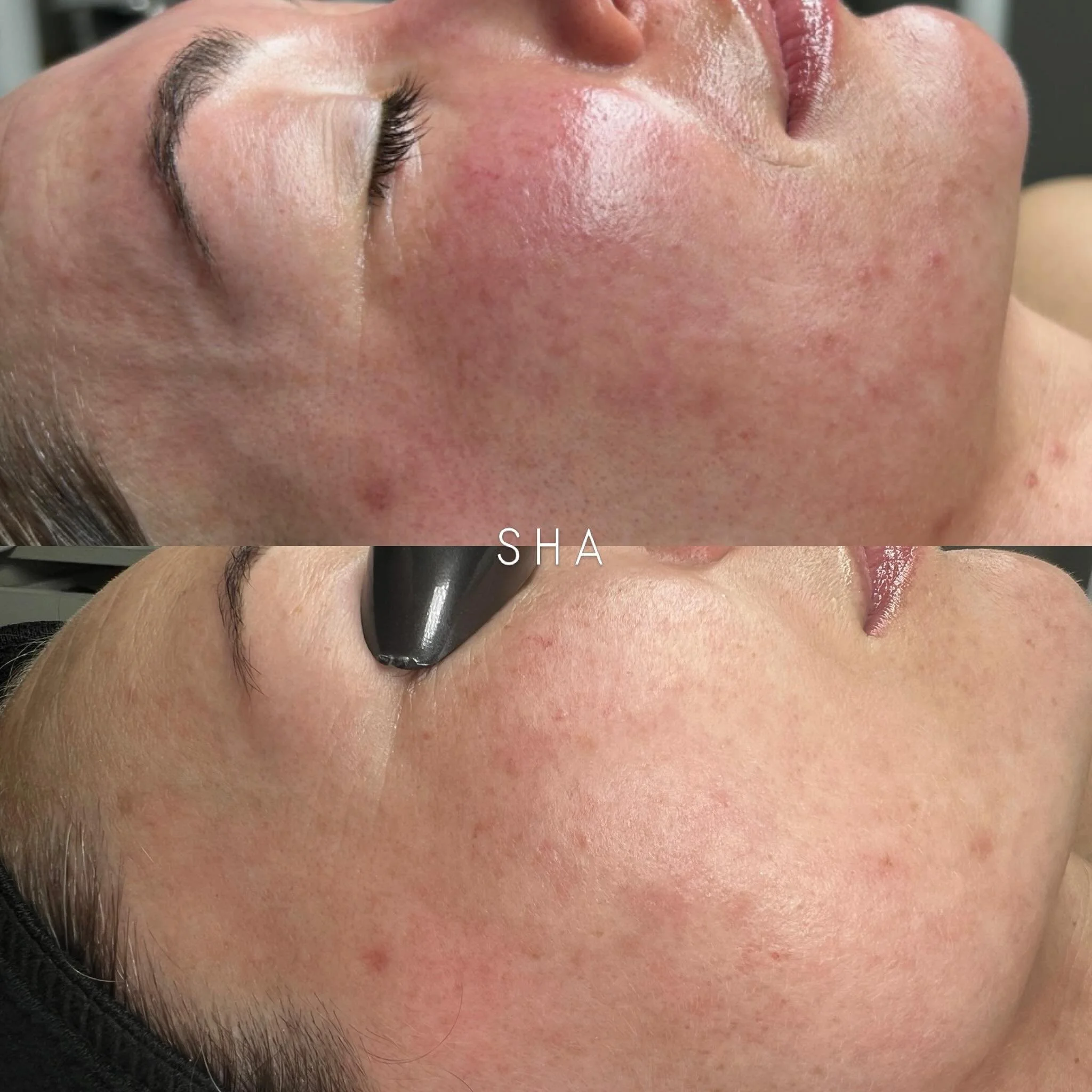 March ➡️ May Acne Transformation 

When she first came to me, her skin was extremely inflamed, reactive, and uncomfortable. Her skin barrier was compromised, leaving her with persistent redness, irritation, breakouts, and congestion throughout her fa