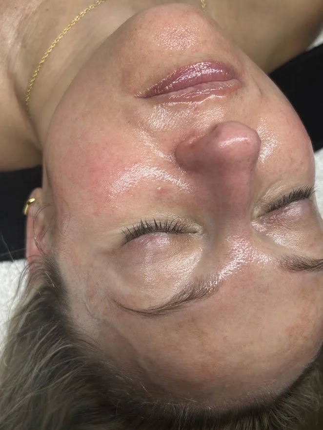 Hydrofacial and hydrodermabrasion treatment at Skin Haven Aesthetics in Eatontown, NJ