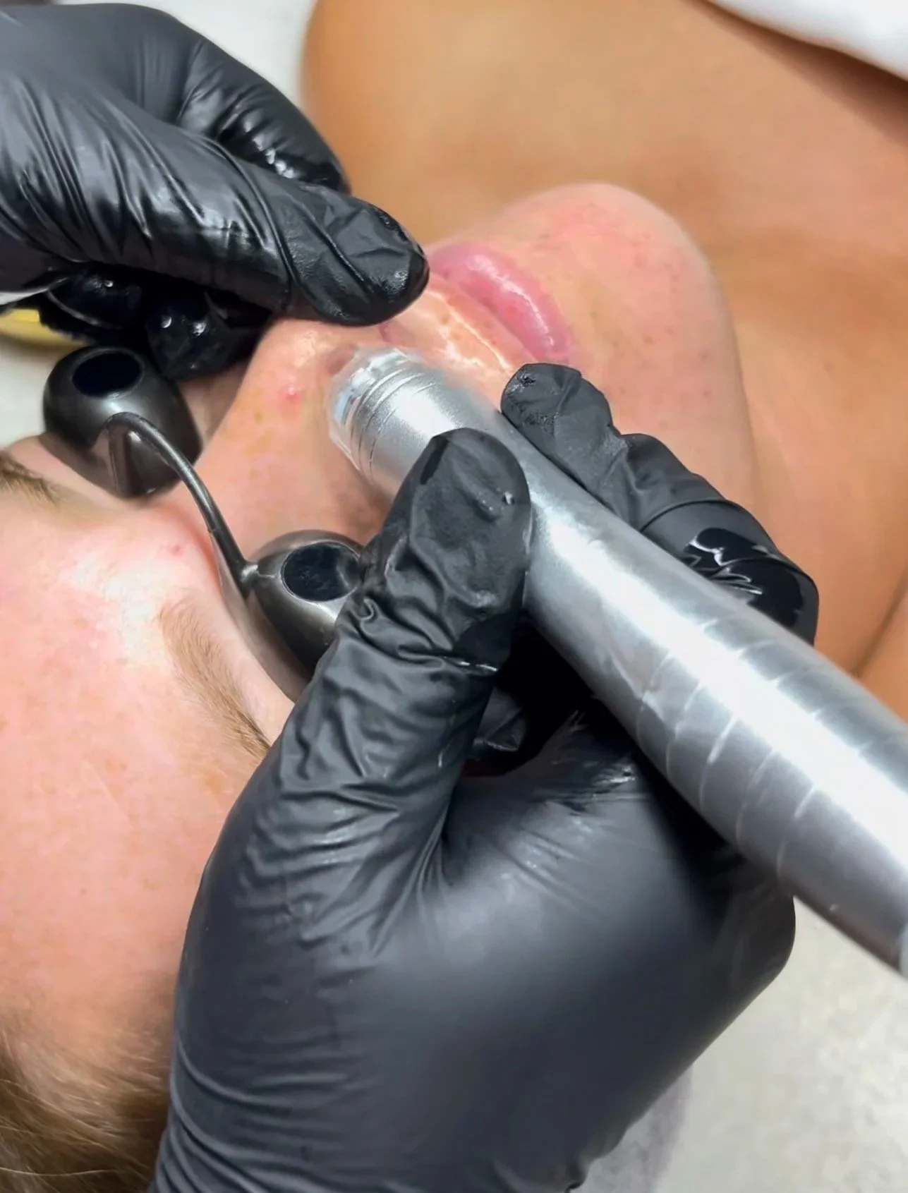 Hydrodermabrasion Hydrofacial at Skin Haven Aesthetics in Eatontown, NJ