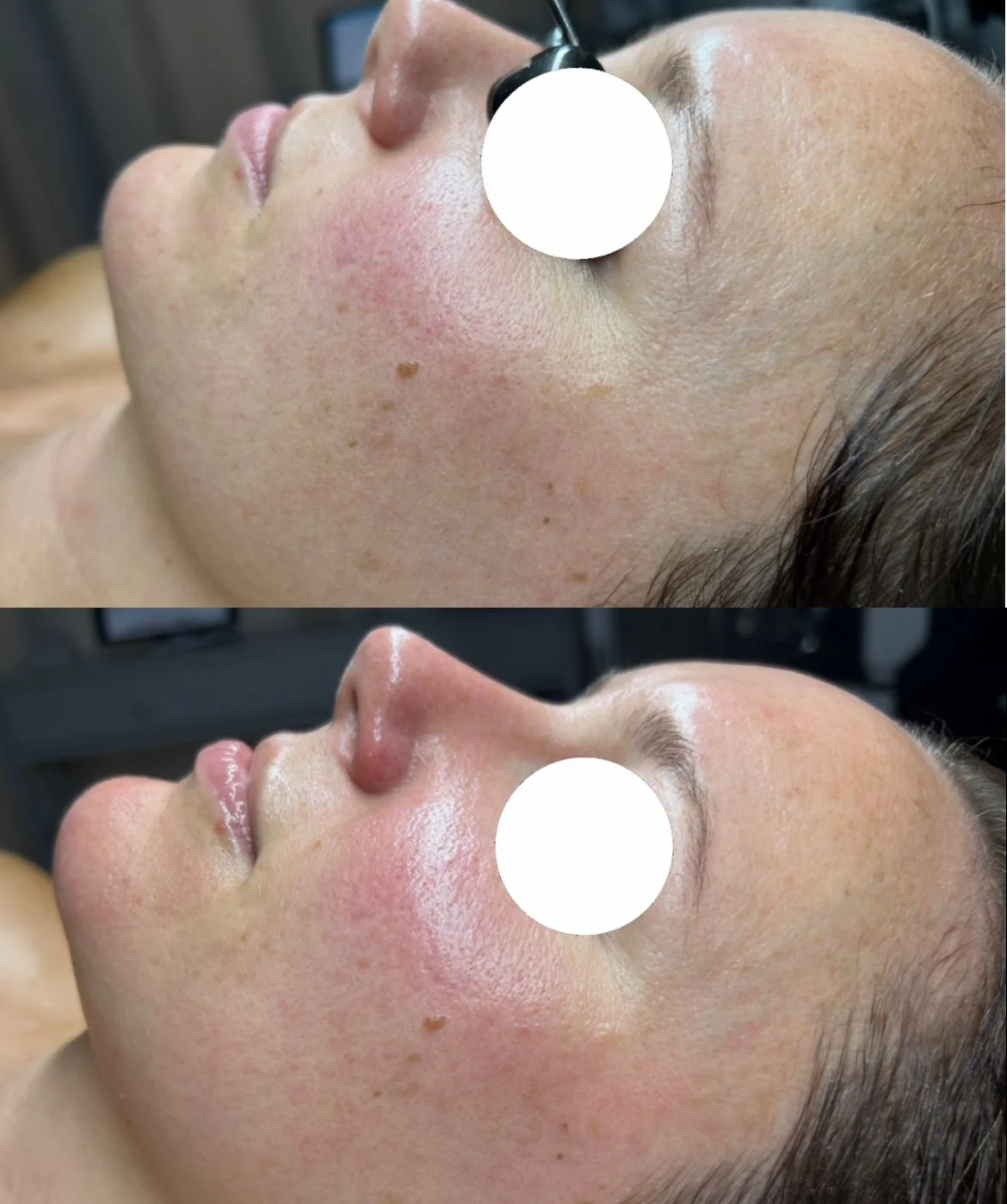CHEMICAL PEEL.PNG