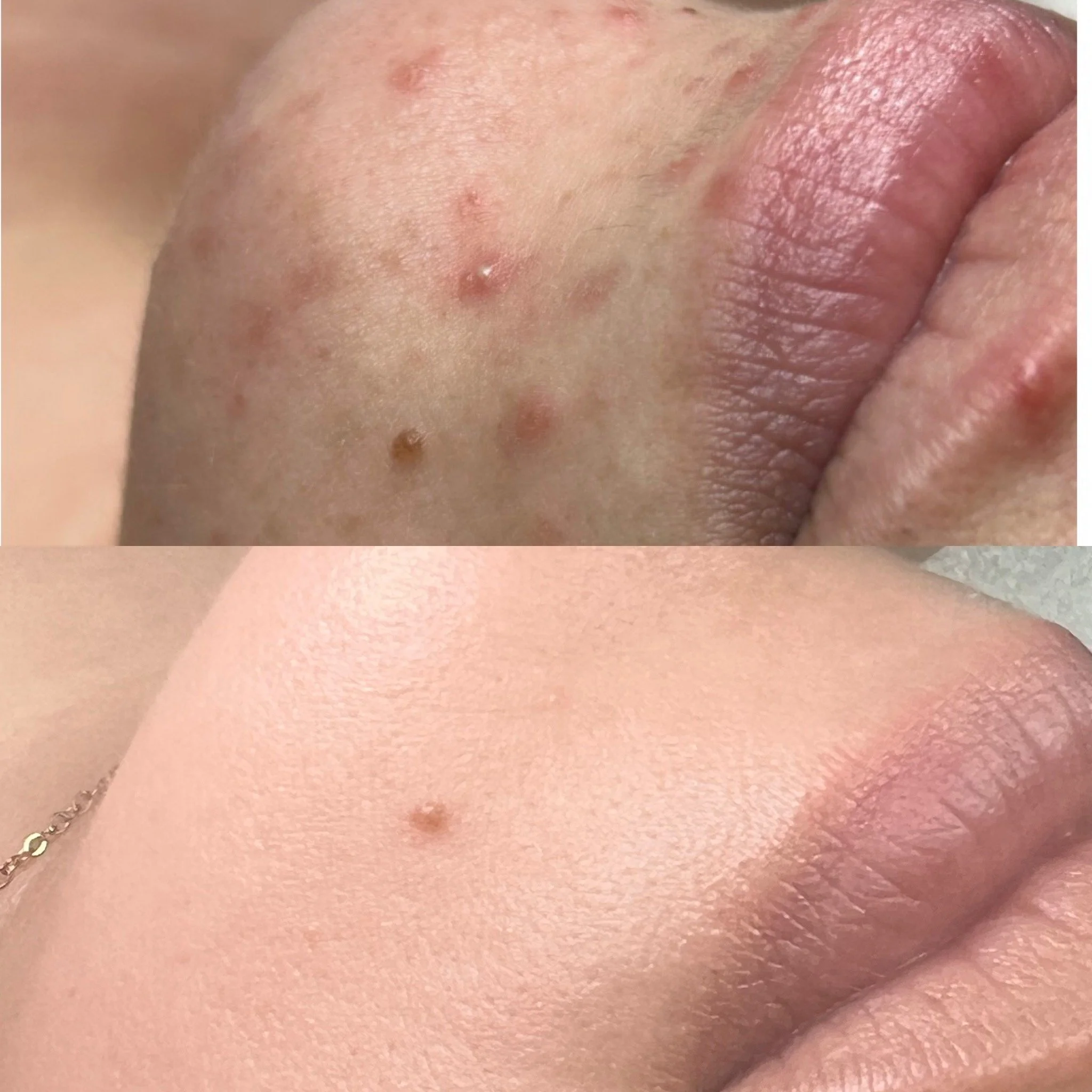 Before and after acne transformation from customized acne treatments in Monmouth County, NJ