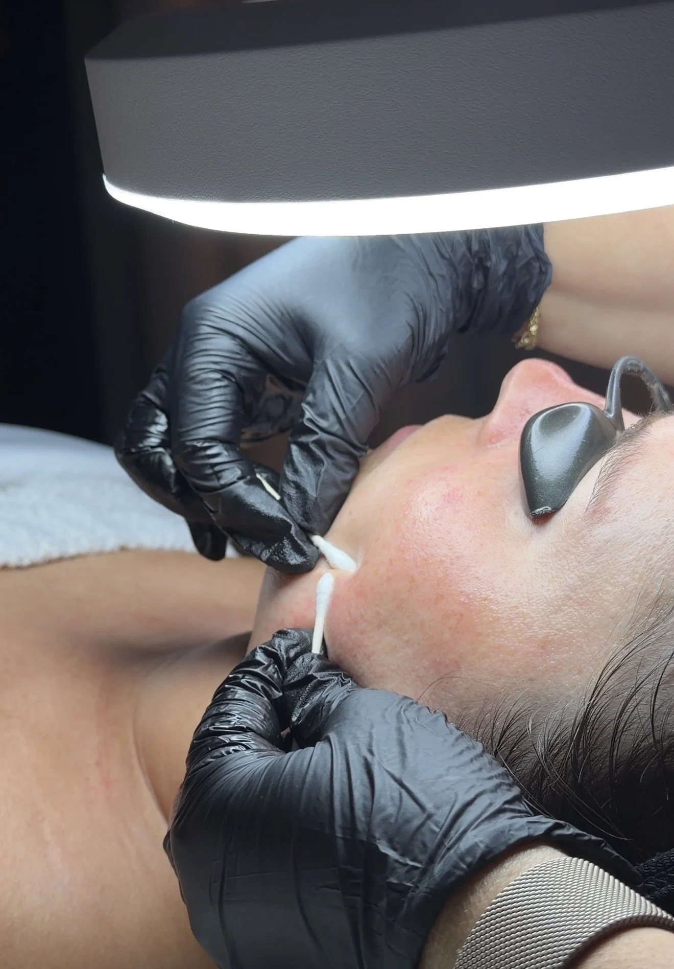 Professional acne treatment at Skin Haven Aesthetics in Eatontown, NJ