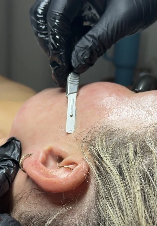 Dermaplane treatment at Skin Haven Aesthetics, Eatontown, NJ
