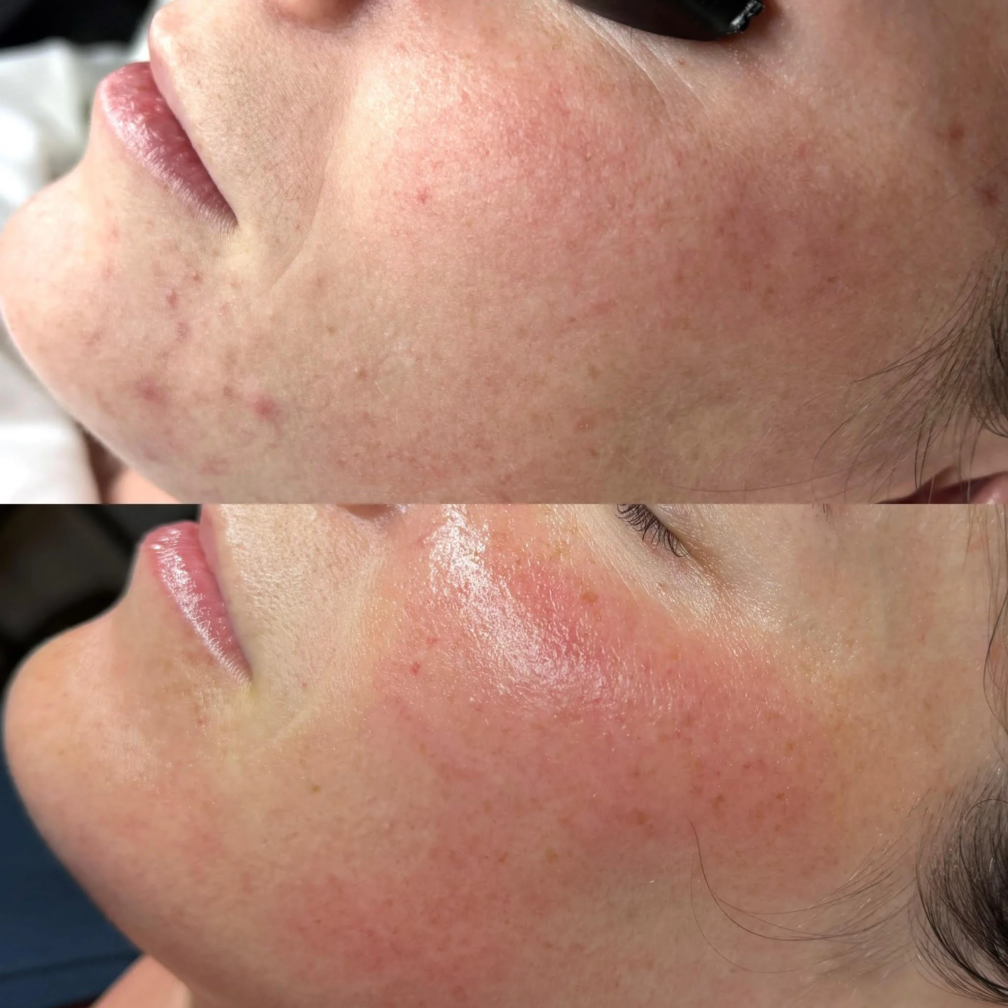 Before and after acne treatment results at Skin Haven Aesthetics in Eatontown, NJ showing improved skin clarity and reduced breakouts