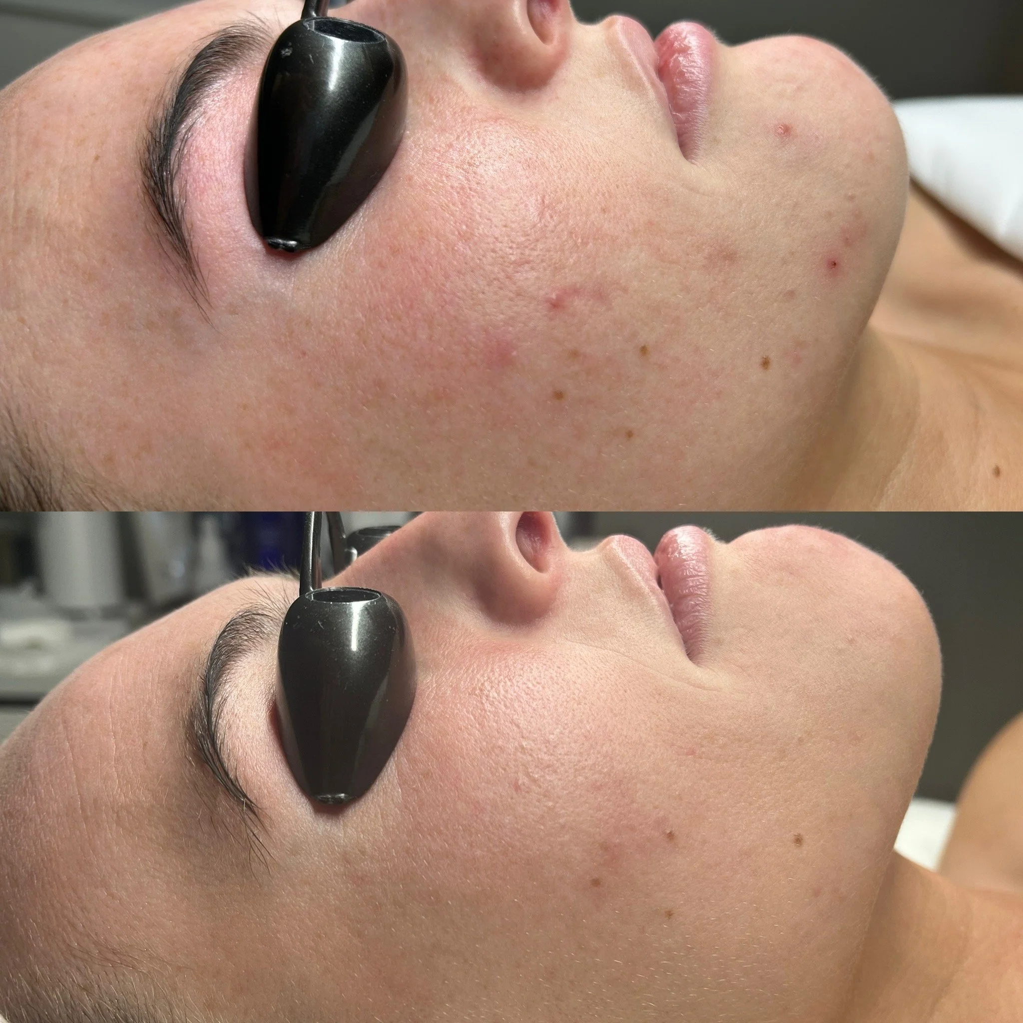 Acne treatment before and after results at Skin Haven Aesthetics in Eatontown, NJ