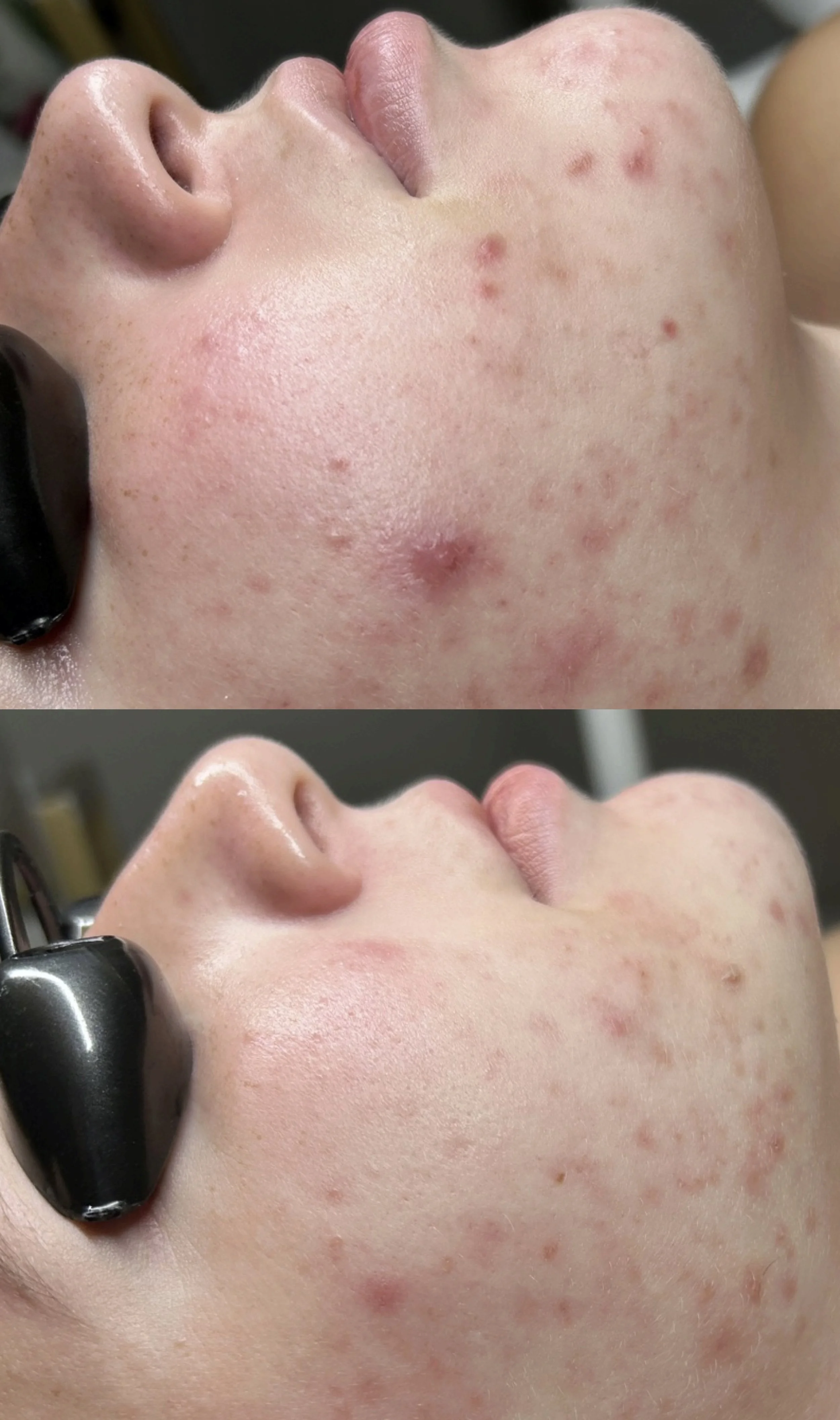 ACNE TREATMENTS.JPG
