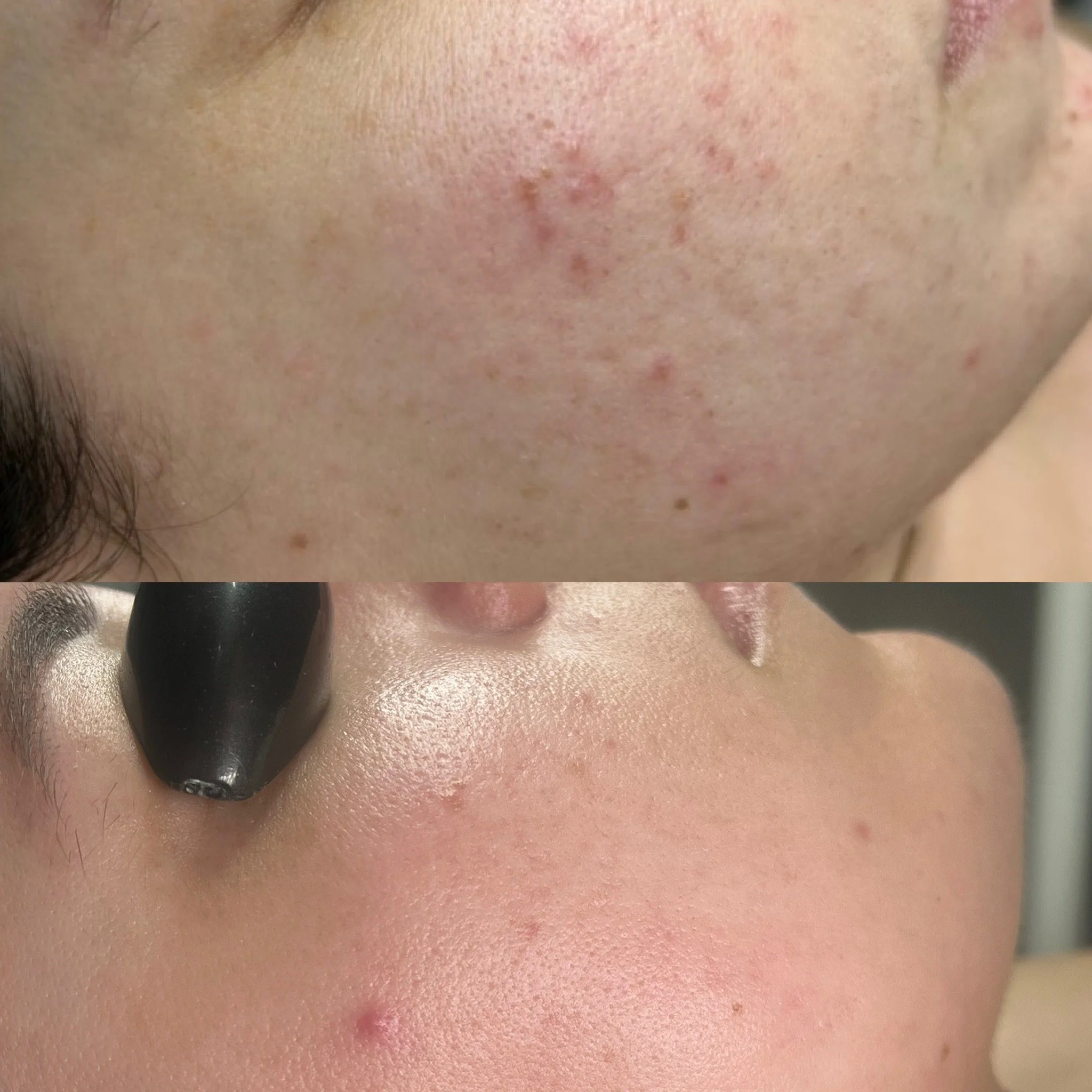 Acne transormation from using face Reality products for customized skin care routine in Monmouth County, NJ