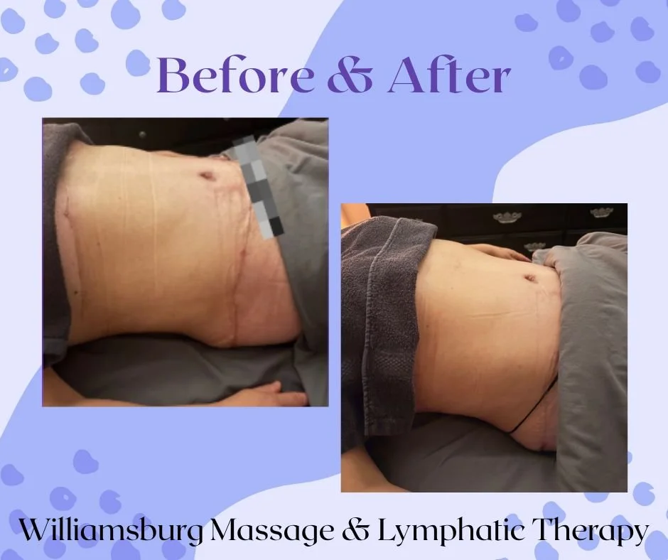 Post Surgical Lymphatic Drainage 