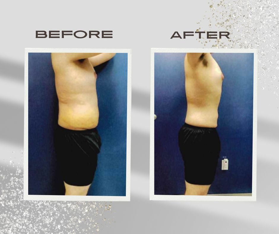 Post Surgical Lymphatic Therapy 2.5 Weeks